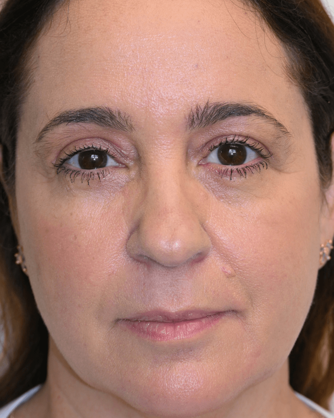 The same patient after the Ziplyft procedure