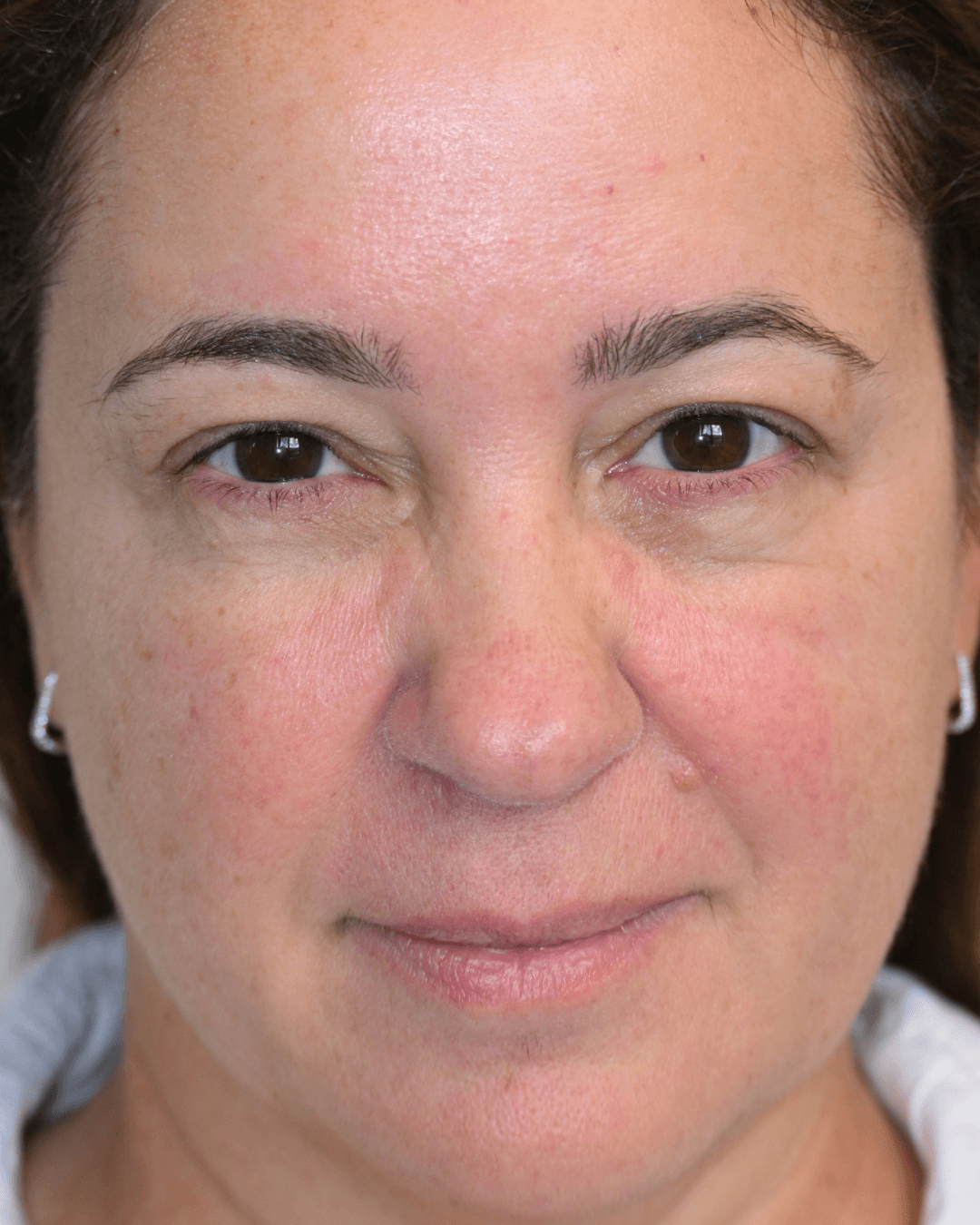 Patient before the Ziplyft procedure
