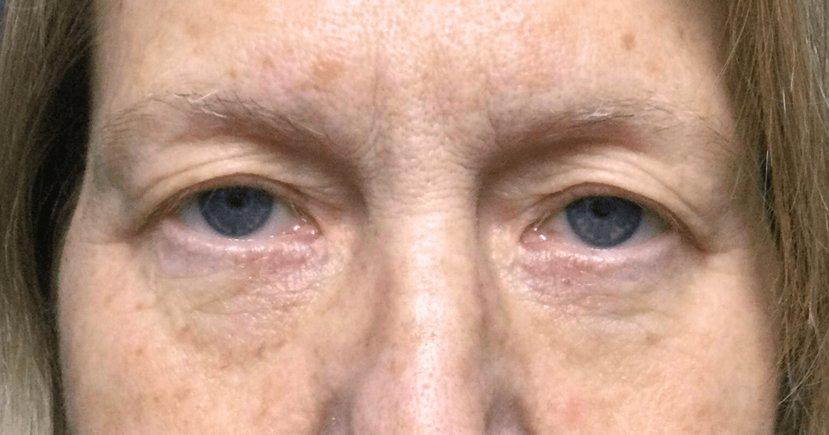 Patient 02 before the Ziplyft procedure