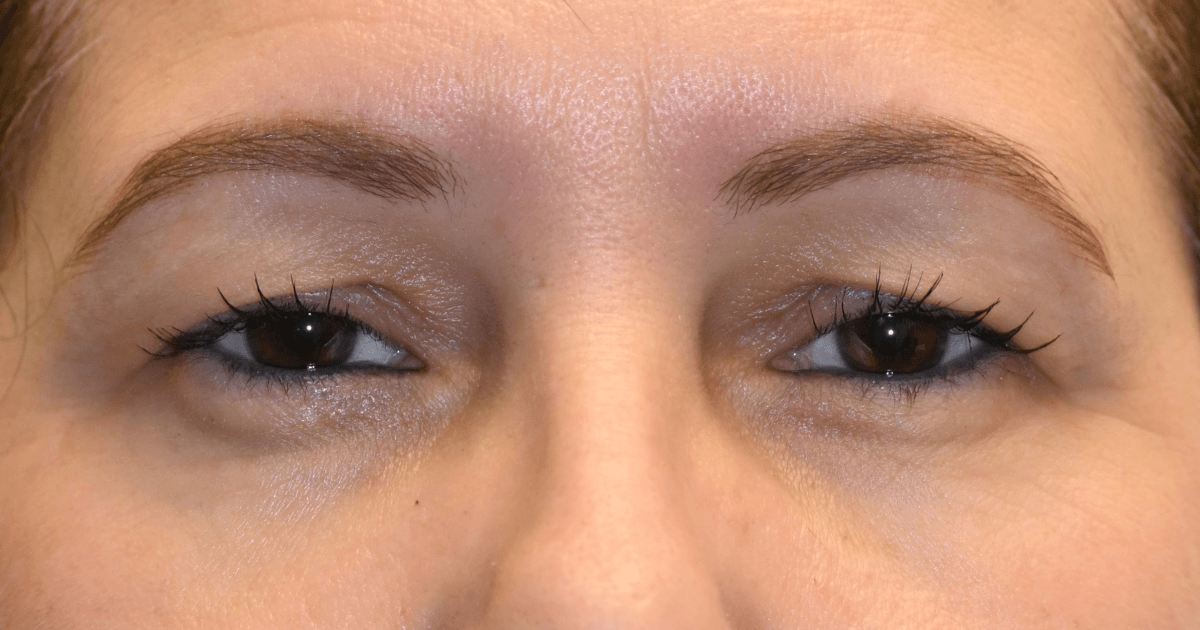 Patient 03 before the Ziplyft procedure