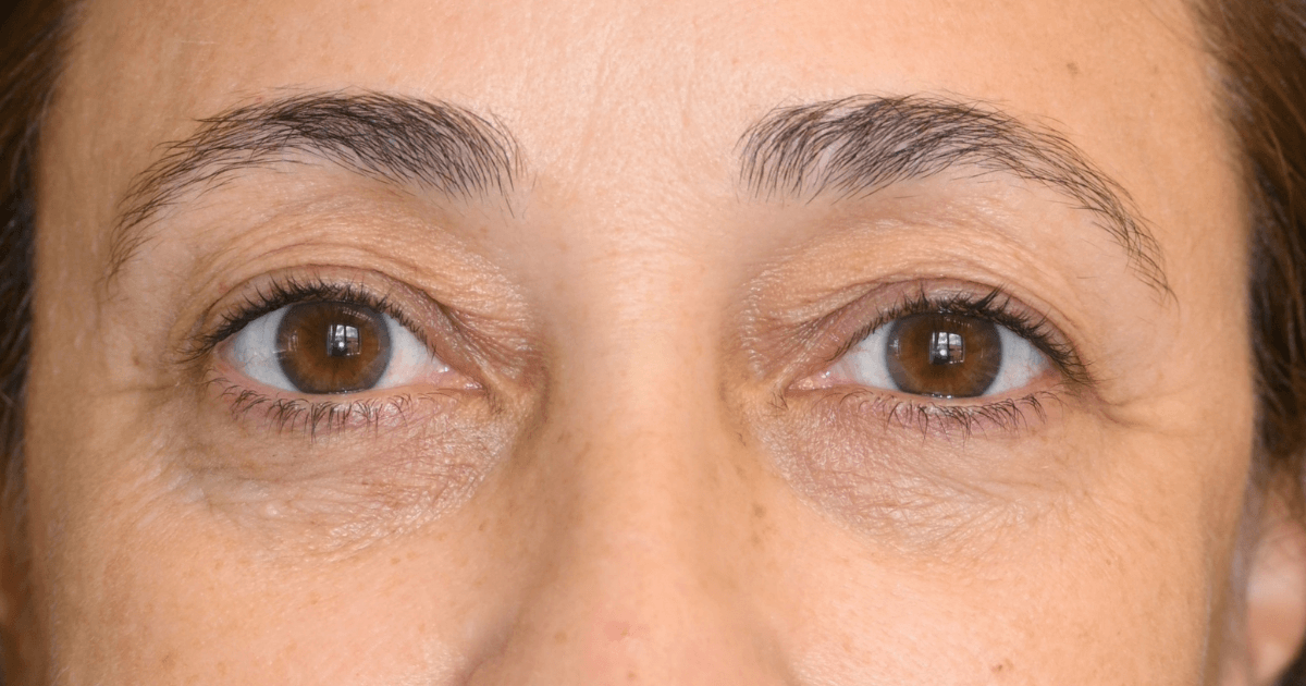 Patient 04 before the Ziplyft procedure