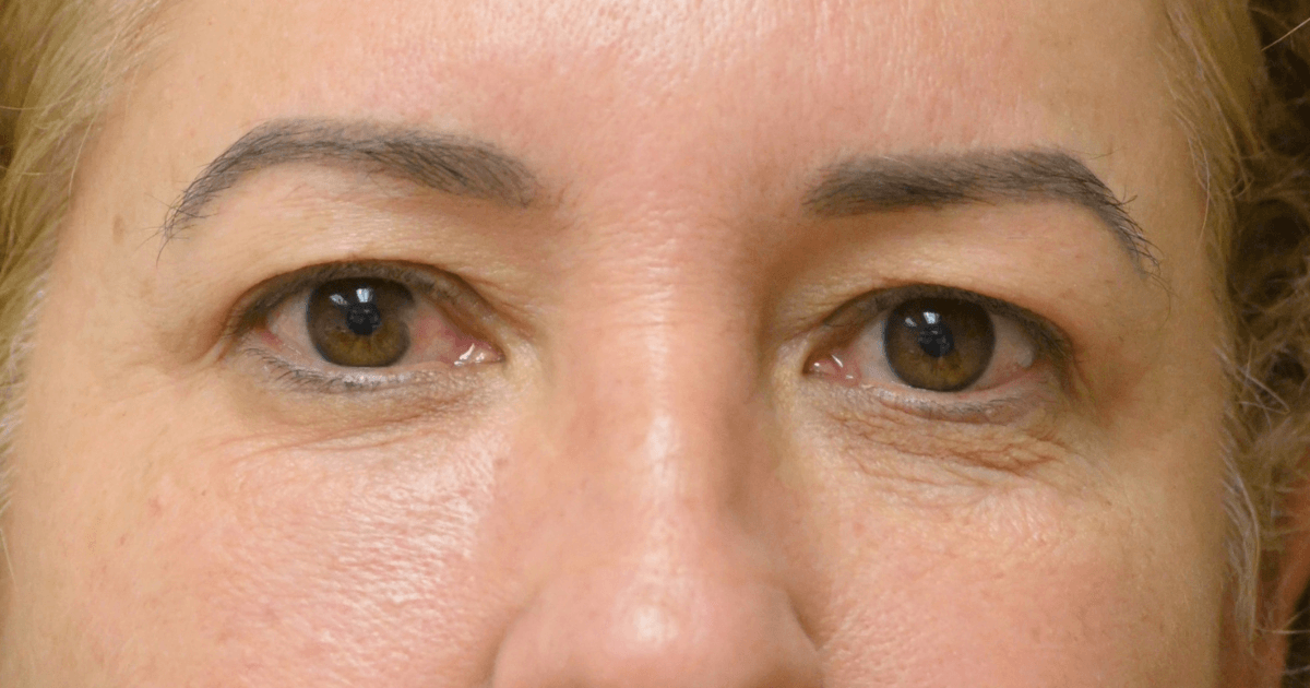 Patient 05 before the Ziplyft procedure