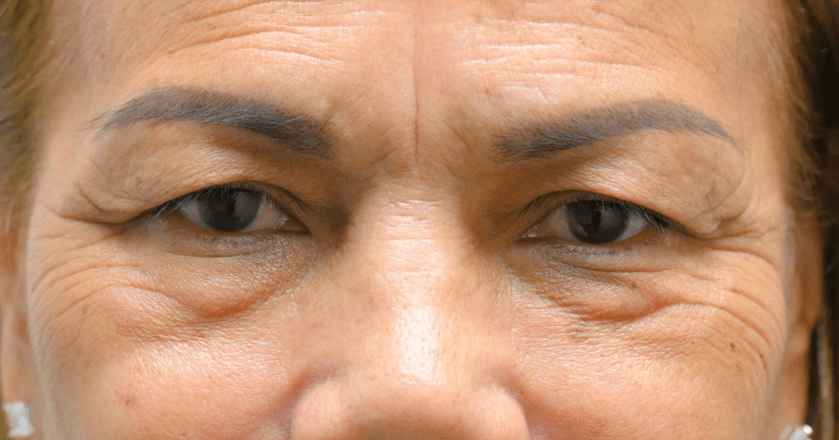Patient 06 before the Ziplyft procedure