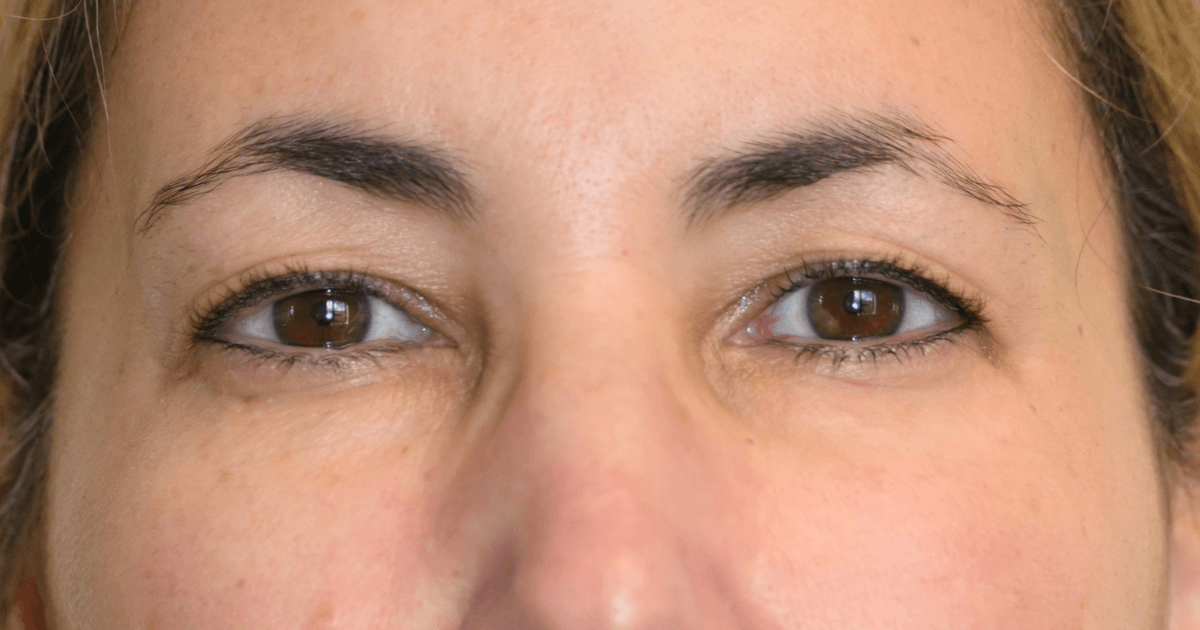 Patient 07 before the Ziplyft procedure