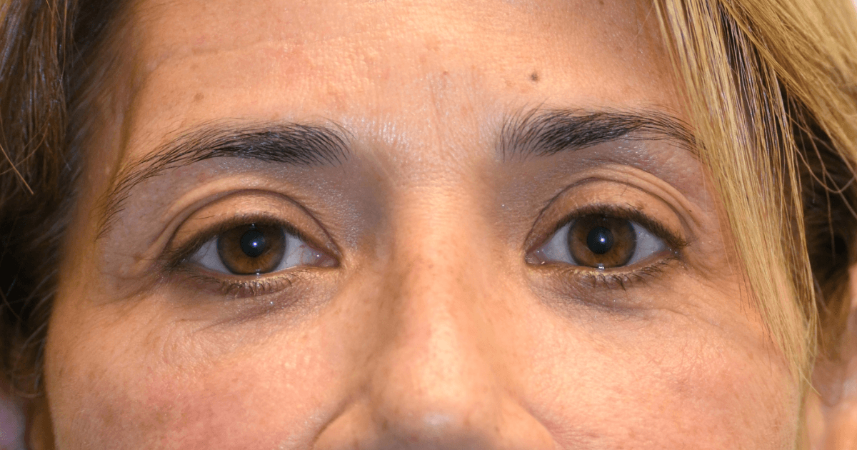 Patient 08 before the Ziplyft procedure