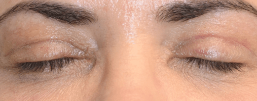 Before Blepharoplasty Surgery