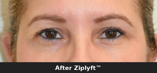 Before eyelid lift procedure