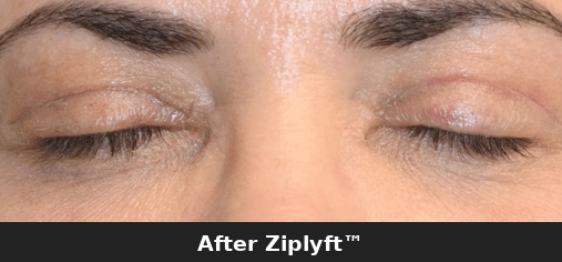 Before eyelid lift procedure
