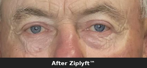 Before eyelid lift procedure