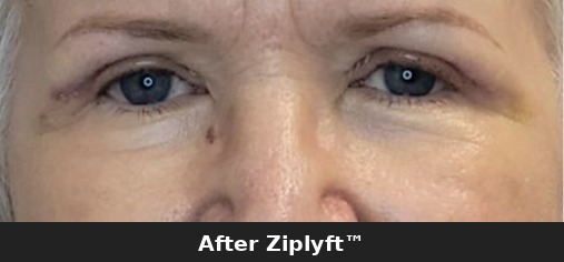 After eyelid lift procedure