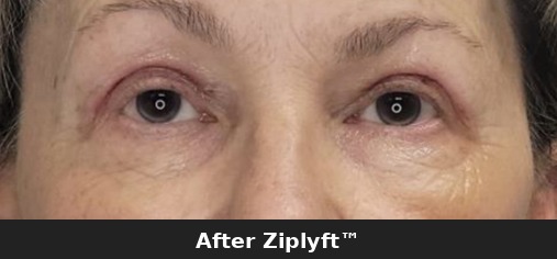 After eyelid lift procedure