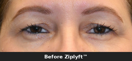 Before eyelid lift procedure