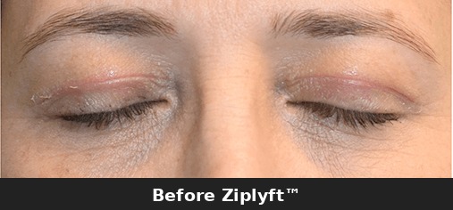 Before eyelid lift procedure