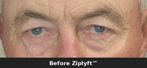 Before eyelid lift procedure