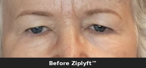 After eyelid lift procedure