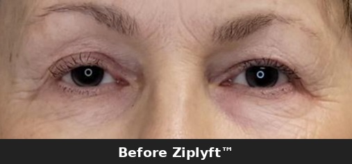 After eyelid lift procedure