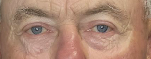 Before Blepharoplasty Surgery