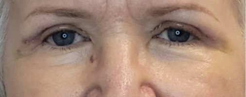 After Blepharoplasty Surgery