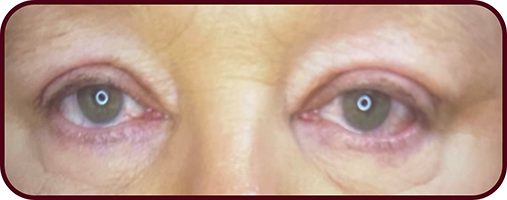 After Blepharoplasty Surgery