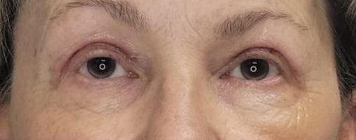 After Blepharoplasty Surgery
