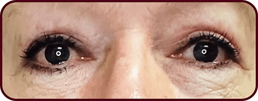 After Blepharoplasty Surgery