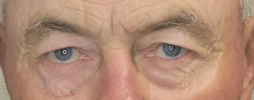 Before Blepharoplasty Surgery