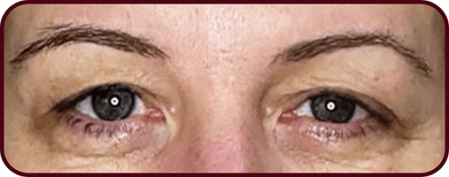 Before Blepharoplasty Surgery