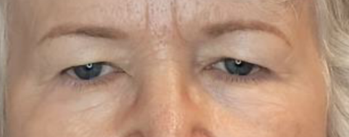 After Blepharoplasty Surgery