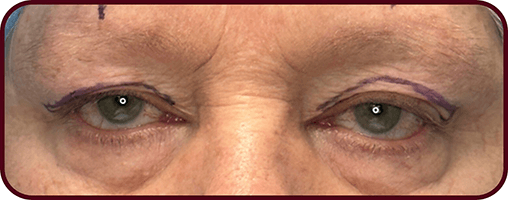 After Blepharoplasty Surgery