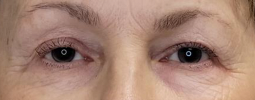 After Blepharoplasty Surgery