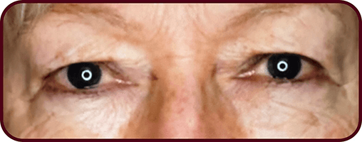 After Blepharoplasty Surgery