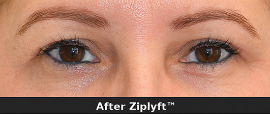 Before eyelid lift procedure